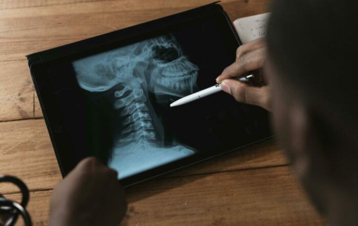 Hernia discal - Fisioterapia Impulso | El Cañaveral, Madrid