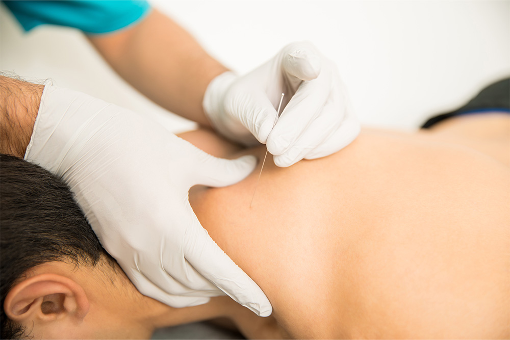 punción seca fisioterapia El Cañaveral Madrid - Clínica Impulso